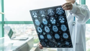 What Is the Most Common Type of Traumatic Brain Injury?