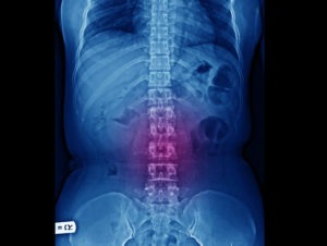 x-ray of a sore spine