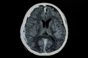 Can I Sue If Someone Else Is to Blame for My TBI?